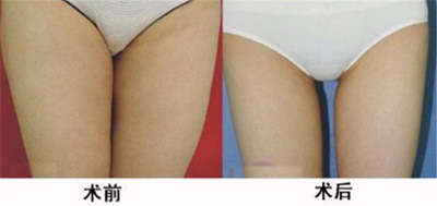 腿部抽脂医院哪里好(选取合适的医院进行腿部抽脂)