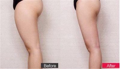 大腿内侧有肥肉怎么减(大腿内侧肥肉怎么减掉)