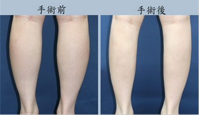 大腿环吸算几个部位(大腿环吸有几个部位)