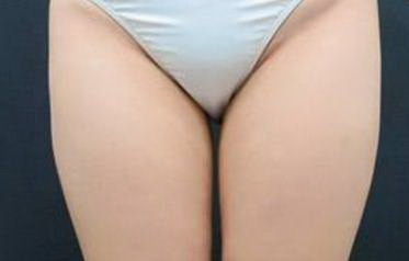 大腿外侧是肌肉还是脂肪_大腿上的生长纹怎么去除