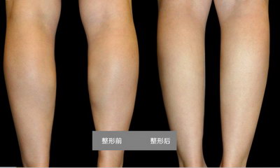 什么快速瘦腿(加强有氧运动)