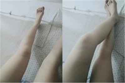 小腿不一样粗怎么纠正(左右小腿不一样粗怎么办)