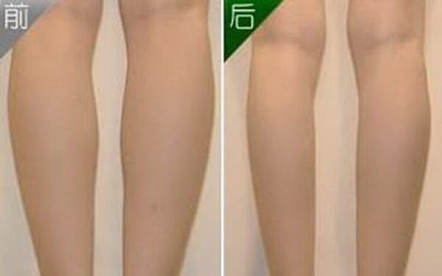 吸脂瘦腿多久可以运动_吸脂瘦腿多久可以好