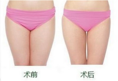 孕妇怎么瘦大腿小腿(孕妇怎样瘦大腿小腿)