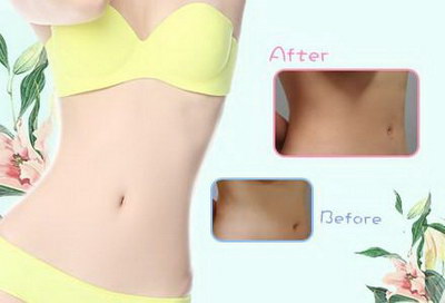 腰腹部吸脂手术需要多少费用呢？