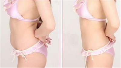 腰部吸脂减肥一般多少钱「腰部吸脂减肥多少钱」