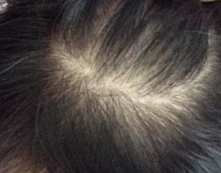 女性脂溢脱发怎么治疗未成年(什么是女性脂溢性脱发？)