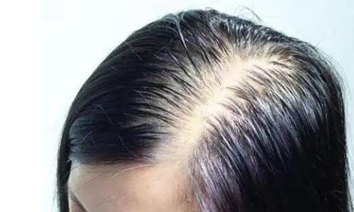 脱发医院治疗(脱发好的医院治疗)