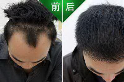 脂溢性脱发如何治疗(脂溢性脱发的原因和表现)
