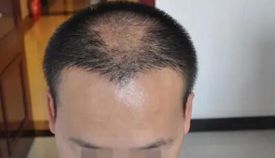 沈阳治疗脱发的医院排名(沈阳治疗脱发医院排名)