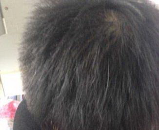 脱发严重可以植发吗(脱发很严重可以植发吗)