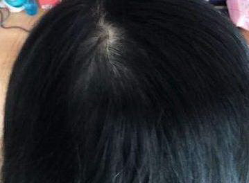 看脱发属于什么科(脱发属于什么)