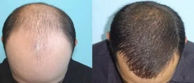 脂溢性脱发怎么根治男性(男性脱发的类型)