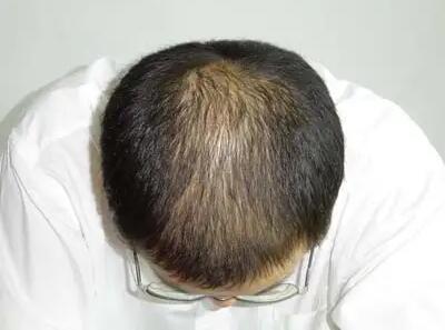 男人脱发是怎么回(男人爱脱发怎么回事)