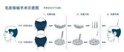 防脱发吃什么(探讨脱发及其原因)