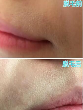 芭乐雅脱毛膏怎么样(芭乐雅脱毛膏的使用效果如何？)