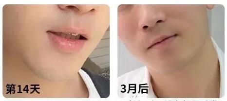 美容院脱毛能永久脱毛吗(理论上说，脱毛可以长久脱毛)
