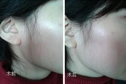 脱毛多久需要脱一次(为什么要脱毛？)