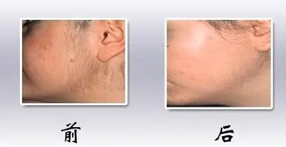 脱毛手术有什么后遗症(表面上的后遗症)