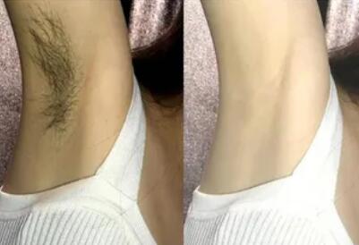 腋毛多久脱一次才好(腋毛的脱除周期该如何规划？)
