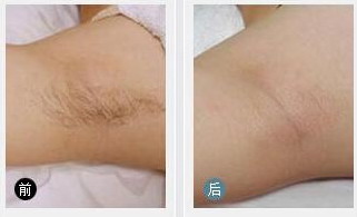 腋下脱毛后多久可以洗澡(腋下脱毛多久可以洗澡)
