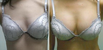 怎么知道乳房假体的破裂的危害(什么是乳房假体？)