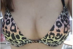 真副乳可以消除吗【腋下副乳怎么可以消除还有异味】