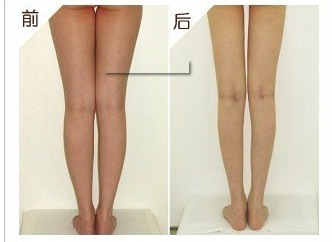 下颌吸脂头套要带多久(下颌吸脂头套要戴多久)