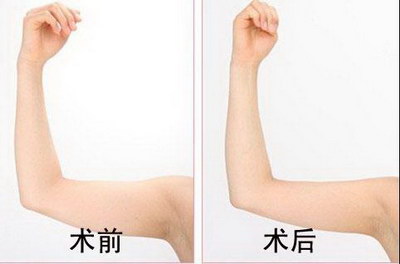 针对大腿不同部位进行的吸脂术
