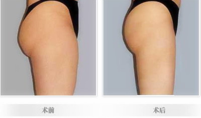 电动负压吸脂瘦腿效果(电动负压吸脂瘦腿效果怎么样)