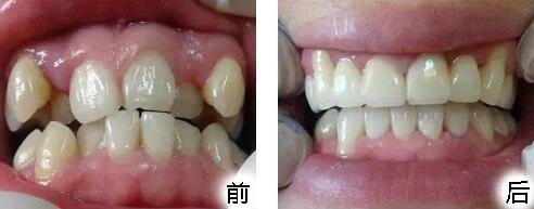 牙齿慢慢变黄(牙齿慢慢变黄是什么)