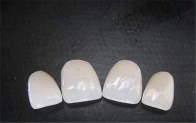 美容全瓷冠整形费用,一般需要多少钱？