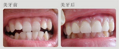全瓷牙价格费用_大概要多少钱?