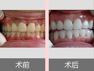 畸形牙齿矫正过程麻烦吗
