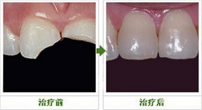 珠海哪家医院做牙齿矫正比较好(珠海牙齿矫正哪家医院比较好)