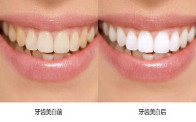 牙齿矫正的方法有哪些呢？