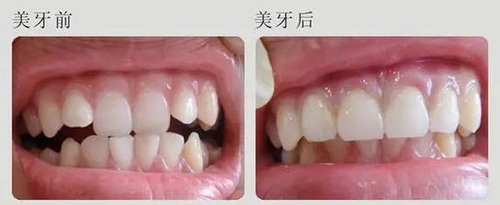 牙龈疼吃什么消炎药最好(牙龈肿个包吃什么消炎药)