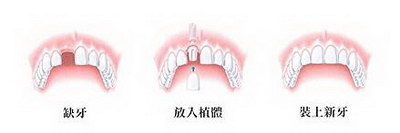 做烤瓷牙的原理是什么黄金烤瓷牙有哪些独特的优势
