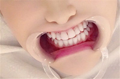 摘了牙套后牙齿发黄