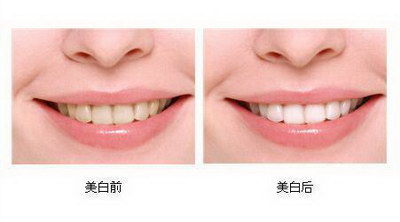 戴隐形透明牙套什么感觉