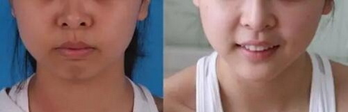牙齿美白的费用是多少？
