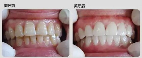 牙齿美白价格贵吗？一般多少费用？