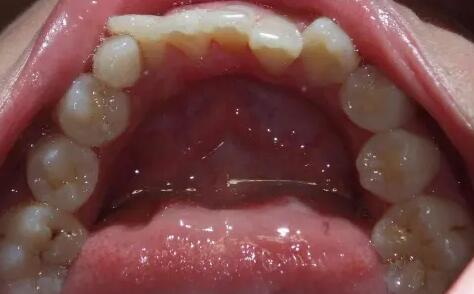 做烤瓷牙的危害有哪些