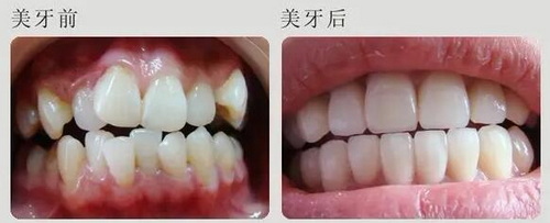 舌侧矫正的费用，贵不贵？