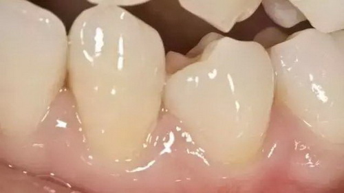 牙齿松动能用水牙线么(牙齿松动能用水牙线吗)