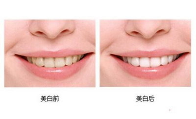 牙齿有缺口怎么补