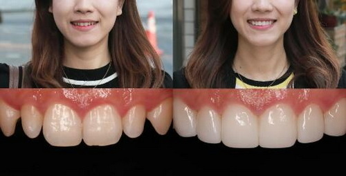 全瓷牙和烤瓷牙有什么不同(全瓷牙和烤瓷牙有什么不同)
