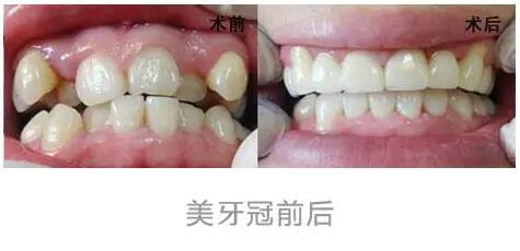 矫正牙齿的最佳年龄阶段是多大呀？