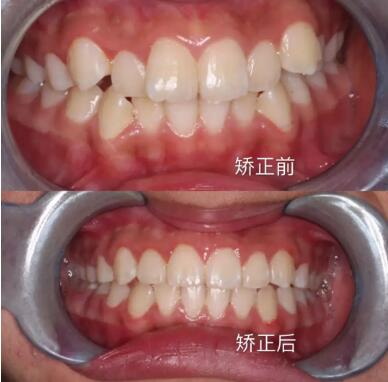 牙髓治疗整形费用贵吗？