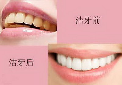 牙龈发炎要多久才可以好(牙龈发炎是什么？)